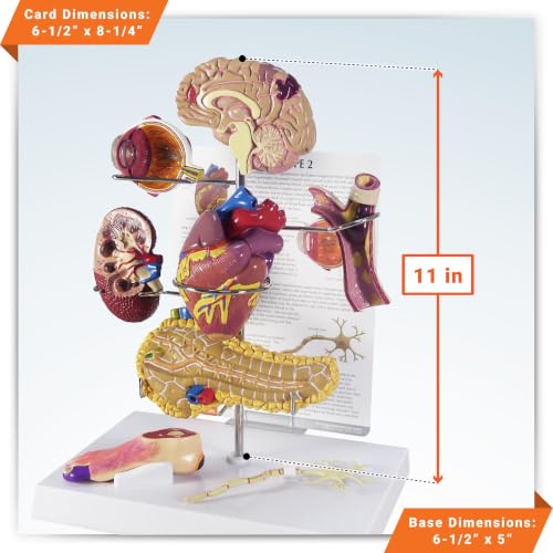GPI Anatomicals Type II Diabetes Model Set - style: Type II Diabetes Model