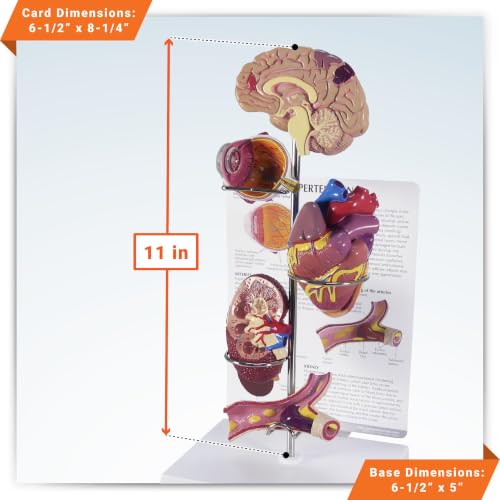 GPI Anatomicals Hypertension Model Set - style: Hypertension Model
