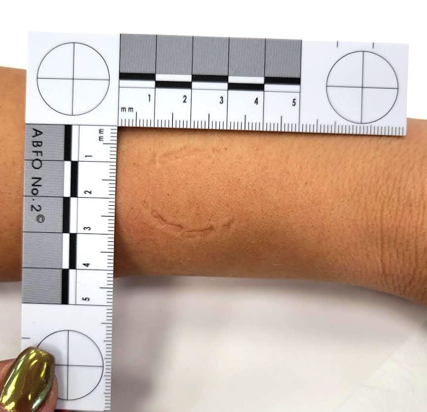 Crime Scene Number 2 Photomacrographic Scale, Metric - 5 Pack - for Bitemark Measurement and Photography - L-Shape