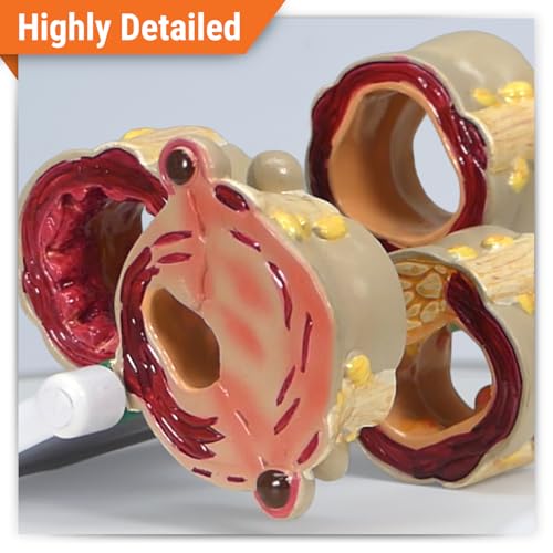 GPI Anatomicals 4-Piece Colon Model, Replica with Pathologies - style: Colon Model