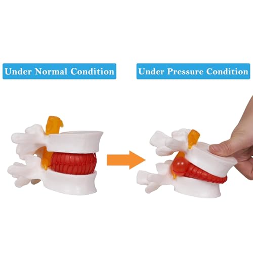 NLShan Human Anatomical Lumbar Disc Herniation Model, Portable Herniated Lumbar Vertebrae Disc, 1.5 Times Life Size Lumbar Spine Model for Learning, Teaching and Demonstrating
