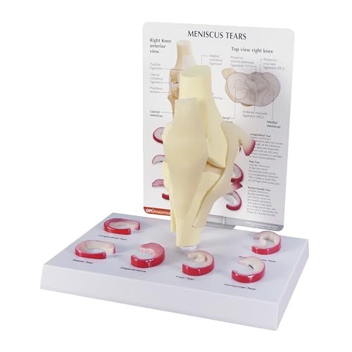 GPI Anatomicals Human Anatomy Model of Knee Joint with Meniscus Tears - style: Knee Joint with Meniscus Tears