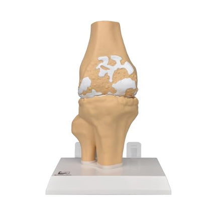 1.2X Enlarged Arthritis Joint Model, Osteoarthritis Anatomy Teaching Tool