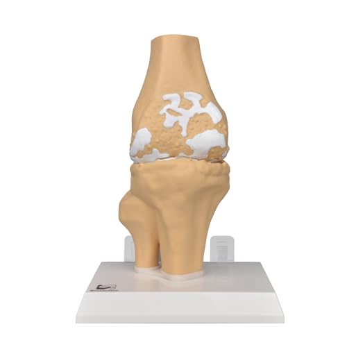 1.2X Enlarged Arthritis Joint Model, Osteoarthritis Anatomy Teaching Tool
