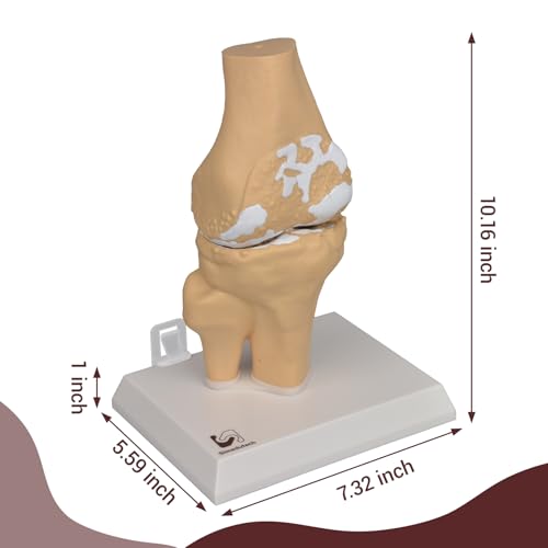 1.2X Enlarged Arthritis Joint Model, Osteoarthritis Anatomy Teaching Tool