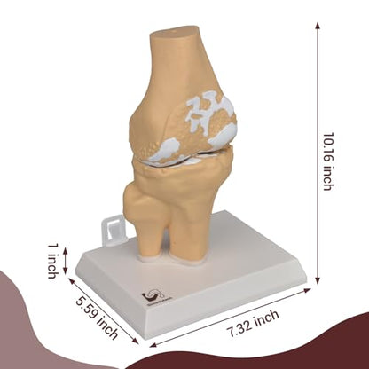 1.2X Enlarged Arthritis Joint Model, Osteoarthritis Anatomy Teaching Tool