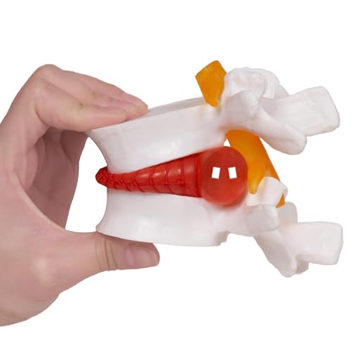 Human Lumbar Disc Herniation Model, 1.5 Times Durable and Lightweight Human Lumbar Disc Model, Visualized Anatomy of Lumbar Disc Herniation, Applied in Learning, Teaching, and Display