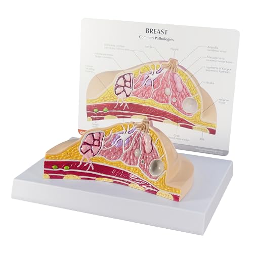 GPI Anatomicals Breast Cross-Section Model Showing Common Pathologies - style: Breast Cross-Section Model