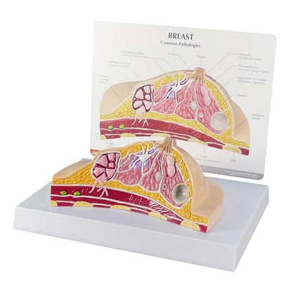 GPI Anatomicals Breast Cross-Section Model Showing Common Pathologies - style: Breast Cross-Section Model