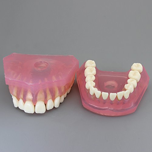 Dental Implant Teeth Model with Removable Teeth for Dental Professionals and Students