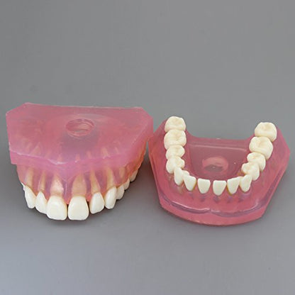 Dental Implant Teeth Model with Removable Teeth for Dental Professionals and Students