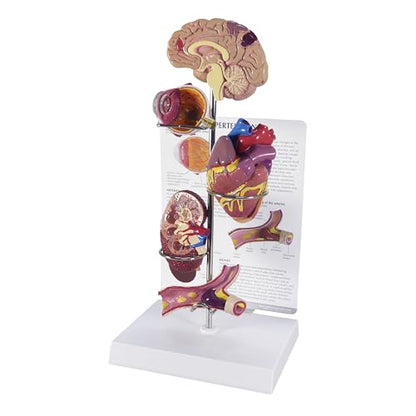 GPI Anatomicals Hypertension Model Set - style: Hypertension Model