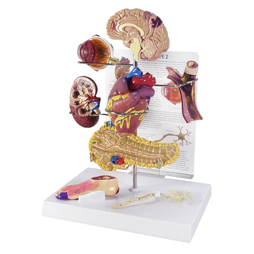 GPI Anatomicals Type II Diabetes Model Set - style: Type II Diabetes Model