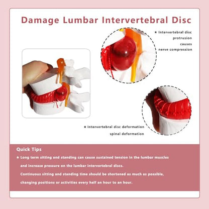 Human Lumbar Disc Herniation Model, 1.5 Times Durable and Lightweight Human Lumbar Disc Model, Visualized Anatomy of Lumbar Disc Herniation, Applied in Learning, Teaching, and Display