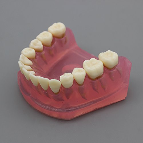 Dental Implant Teeth Model with Removable Teeth for Dental Professionals and Students