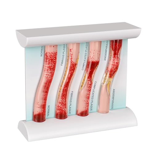 4-Stage Atherosclerosis Artery Model, LDL Plaque Blood Vessel Teaching Aid