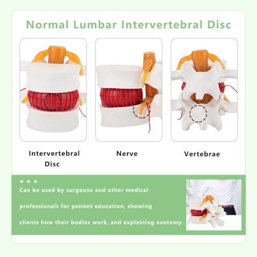 Human Lumbar Disc Herniation Model, 1.5 Times Durable and Lightweight Human Lumbar Disc Model, Visualized Anatomy of Lumbar Disc Herniation, Applied in Learning, Teaching, and Display