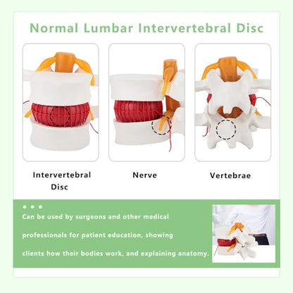 Human Lumbar Disc Herniation Model, 1.5 Times Durable and Lightweight Human Lumbar Disc Model, Visualized Anatomy of Lumbar Disc Herniation, Applied in Learning, Teaching, and Display