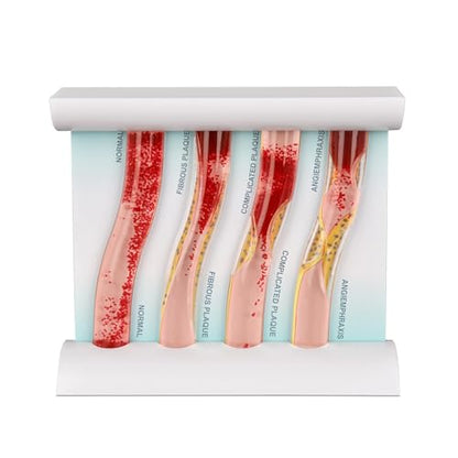 4-Stage Atherosclerosis Artery Model, LDL Plaque Blood Vessel Teaching Aid