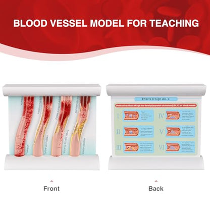 4-Stage Atherosclerosis Artery Model, LDL Plaque Blood Vessel Teaching Aid