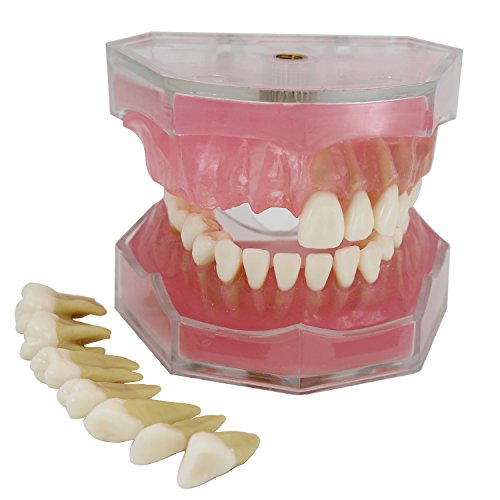 Dental Implant Teeth Model with Removable Teeth for Dental Professionals and Students