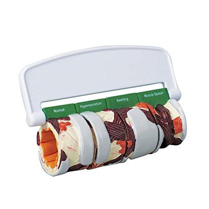 GPI Anatomicals 4-Piece Bronchus Model, Replica with Pathologies - style: Bronchus Model