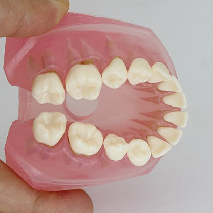 Dental Implant Teeth Model with Removable Teeth for Dental Professionals and Students