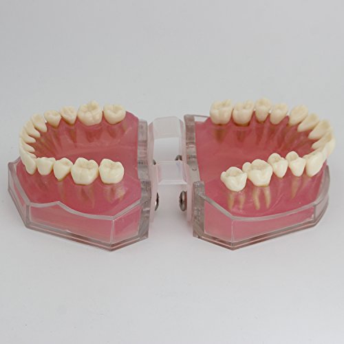 Dental Implant Teeth Model with Removable Teeth for Dental Professionals and Students