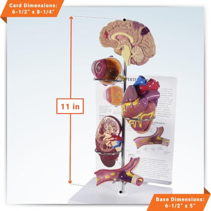 GPI Anatomicals Hypertension Model Set - style: Hypertension Model