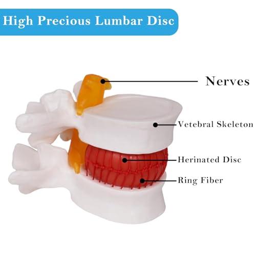NLShan Human Anatomical Lumbar Disc Herniation Model, Portable Herniated Lumbar Vertebrae Disc, 1.5 Times Life Size Lumbar Spine Model for Learning, Teaching and Demonstrating