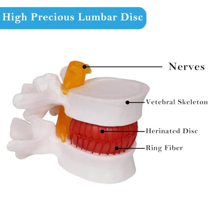 NLShan Human Anatomical Lumbar Disc Herniation Model, Portable Herniated Lumbar Vertebrae Disc, 1.5 Times Life Size Lumbar Spine Model for Learning, Teaching and Demonstrating