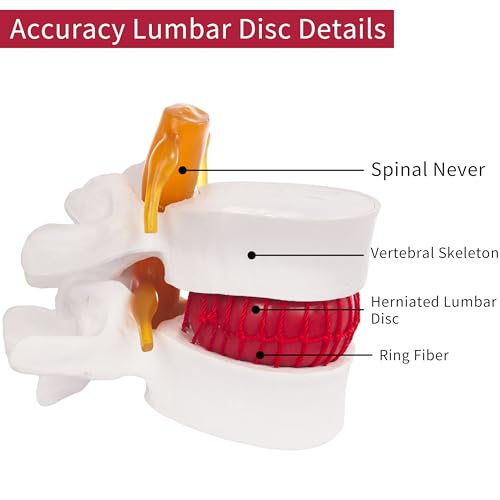 1.5X Life-Size Lumbar Disc Herniation Model, Spine Anatomy Model - style: Anatomical Lumbar Disc Herniation Model