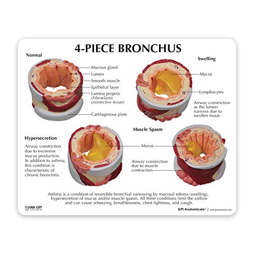 GPI Anatomicals 4-Piece Bronchus Model, Replica with Pathologies - style: Bronchus Model