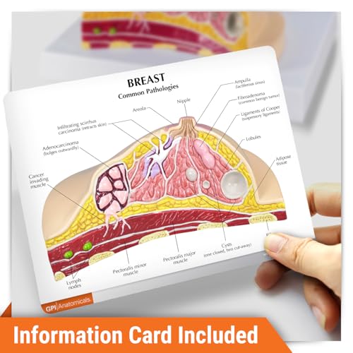 GPI Anatomicals Breast Cross-Section Model Showing Common Pathologies - style: Breast Cross-Section Model