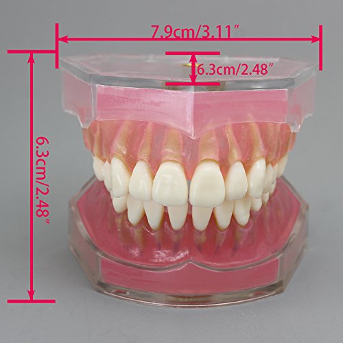 Dental Implant Teeth Model with Removable Teeth for Dental Professionals and Students