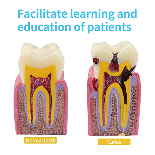 Dental Caries Teeth Model,Dental Anatomy Education Tooth Model,6 Times Caries Teaching Typodont Tool for Dentists, Patients, Teachers and Students