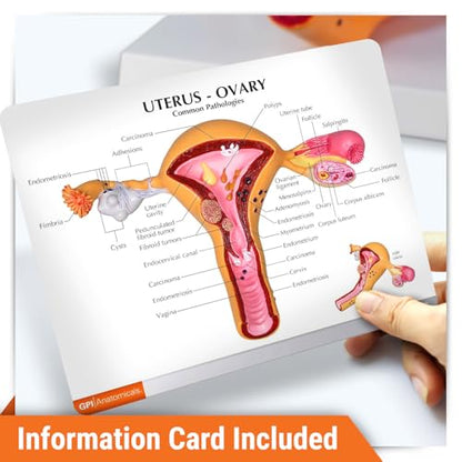 GPI Anatomicals Uterus and Ovary Model, Female Reproductive System - style: Uterus and ovary