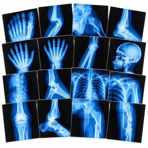 16 Pcs Broken Bones X-Ray Set Human Anatomy STEM Classroom Learning Films