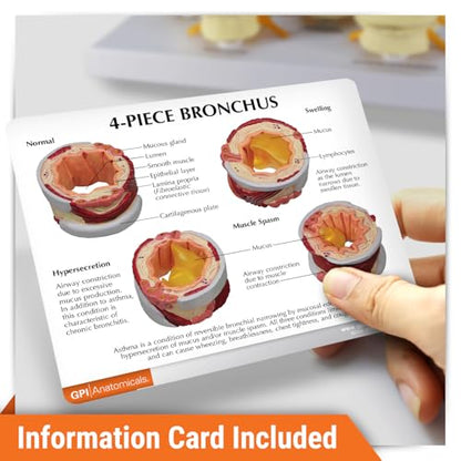 GPI Anatomicals 4-Piece Bronchus Model, Replica with Pathologies - style: Bronchus Model